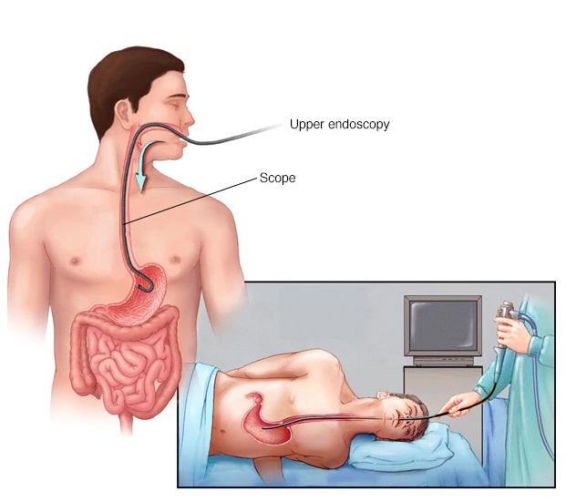 Upper Gastrointestinal Endoscopy | Gastroenterology