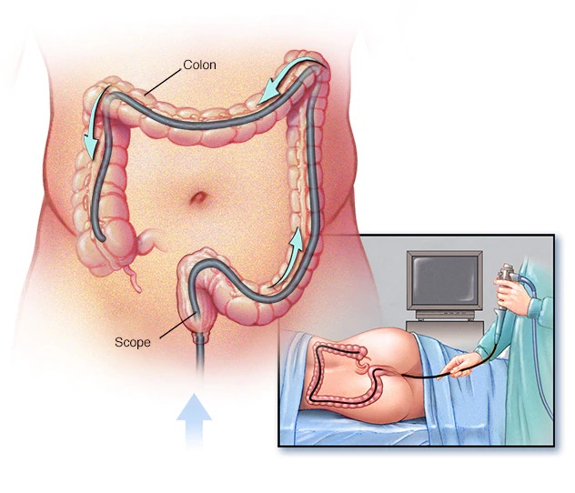 Colonoscopy Test | Gastroenterologist