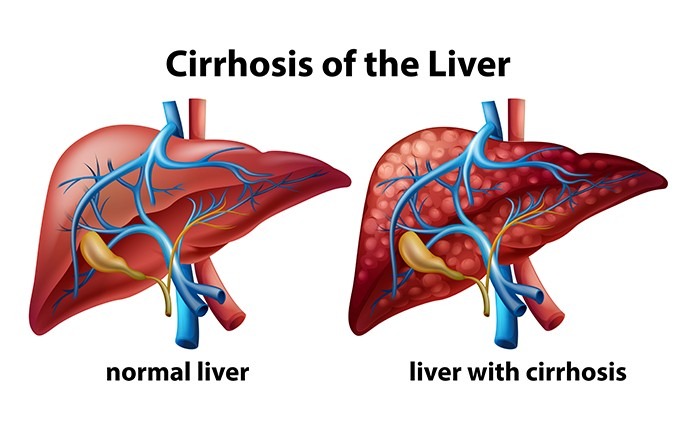 What is Cirrhosis?