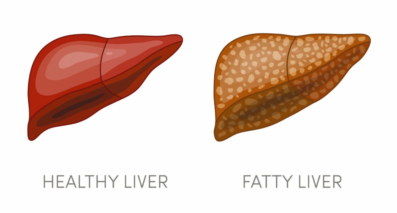 What is a Fatty Liver?