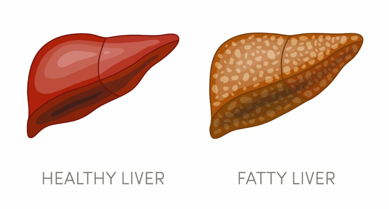 what-is-a-fatty-liver