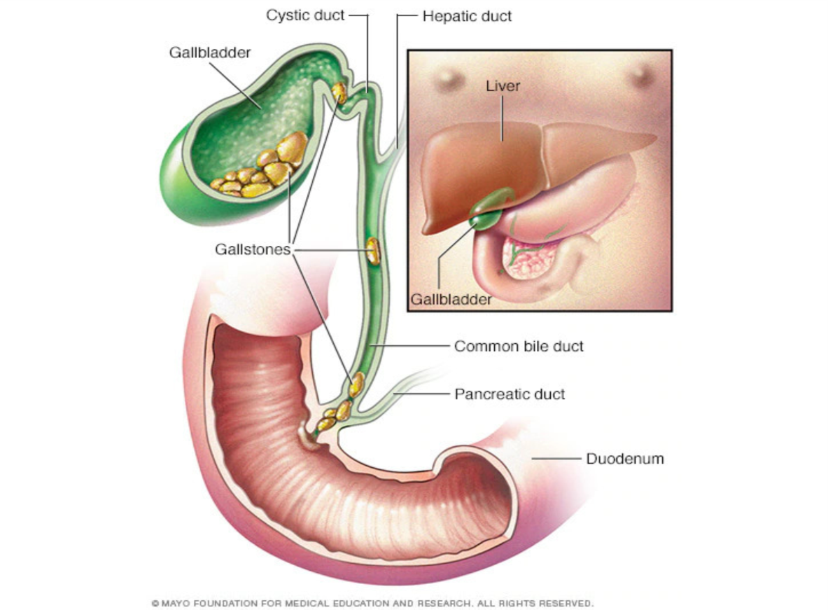 gall stone problem